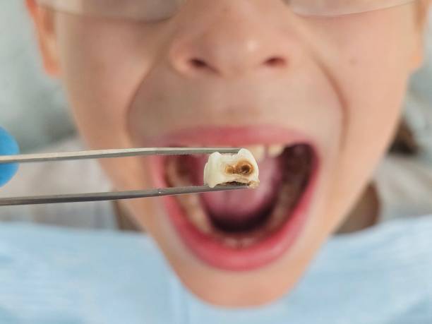 Best Emergency Wisdom Teeth Removal in Fairfield Harbour, NC